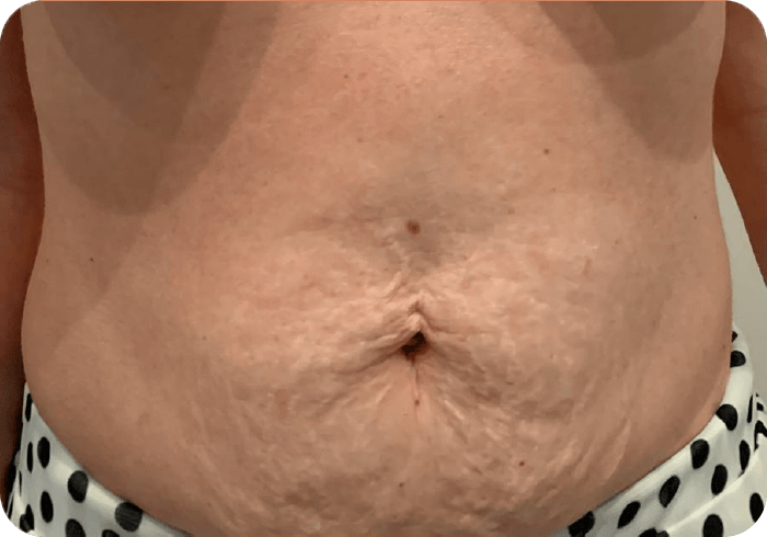 Tratamiento FHOS antes