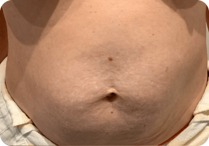 Tratamiento FHOS después