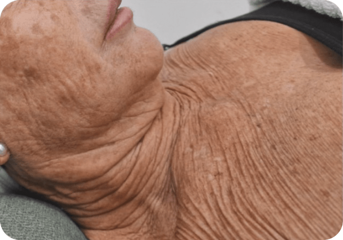 Tratamiento FHOS antes