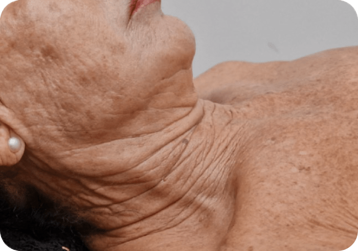 Tratamiento FHOS después