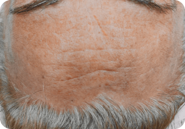 Tratamiento FHOS depués