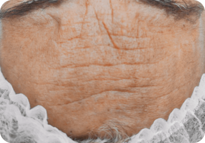 Tratamiento FHOS antes