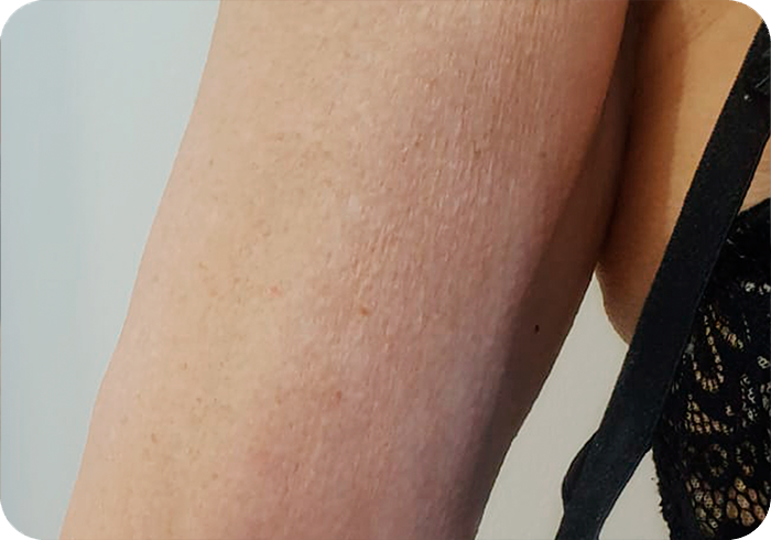 Tratamiento FHOS depués