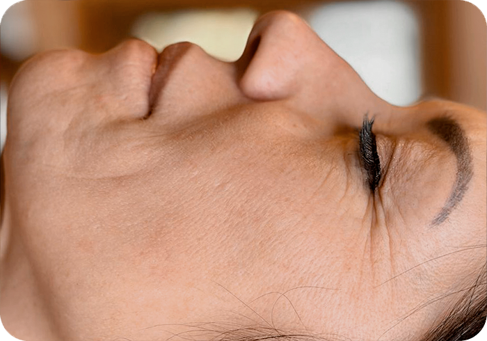 Tratamiento FHOS antes