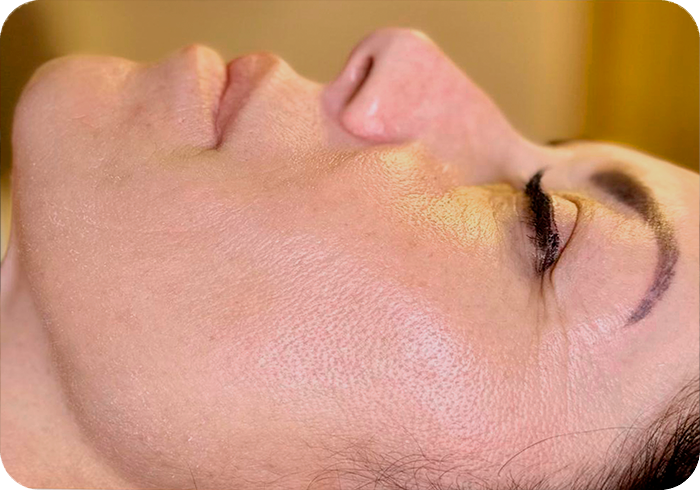 Tratamiento FHOS después