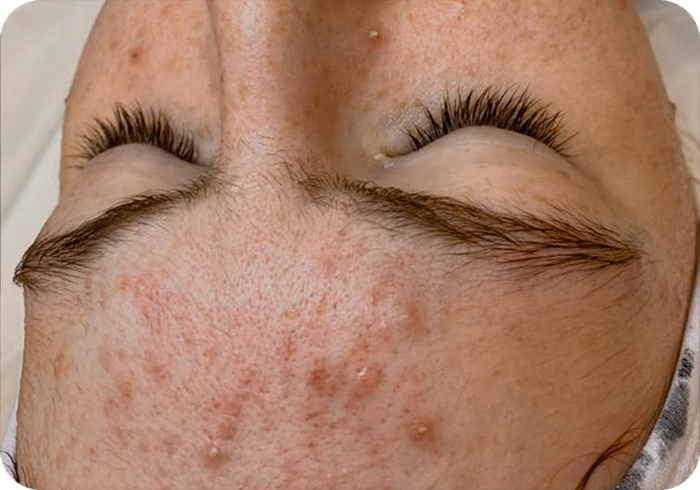 Tratamiento FHOS antes