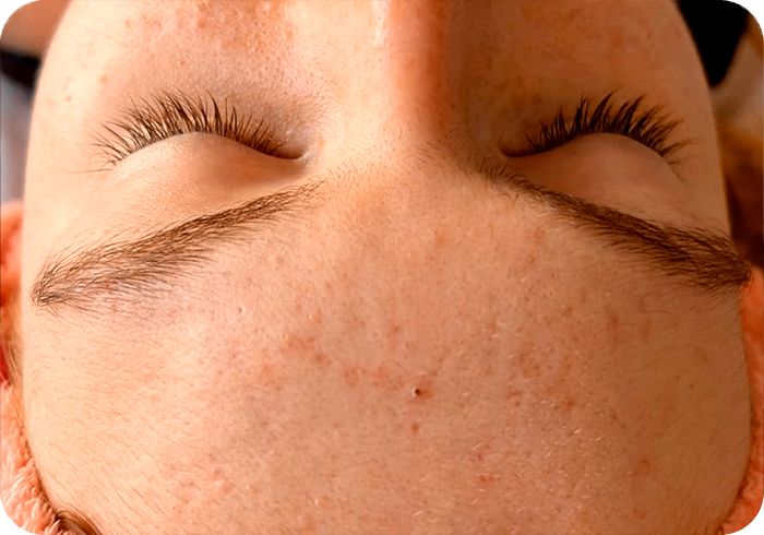 Tratamiento después